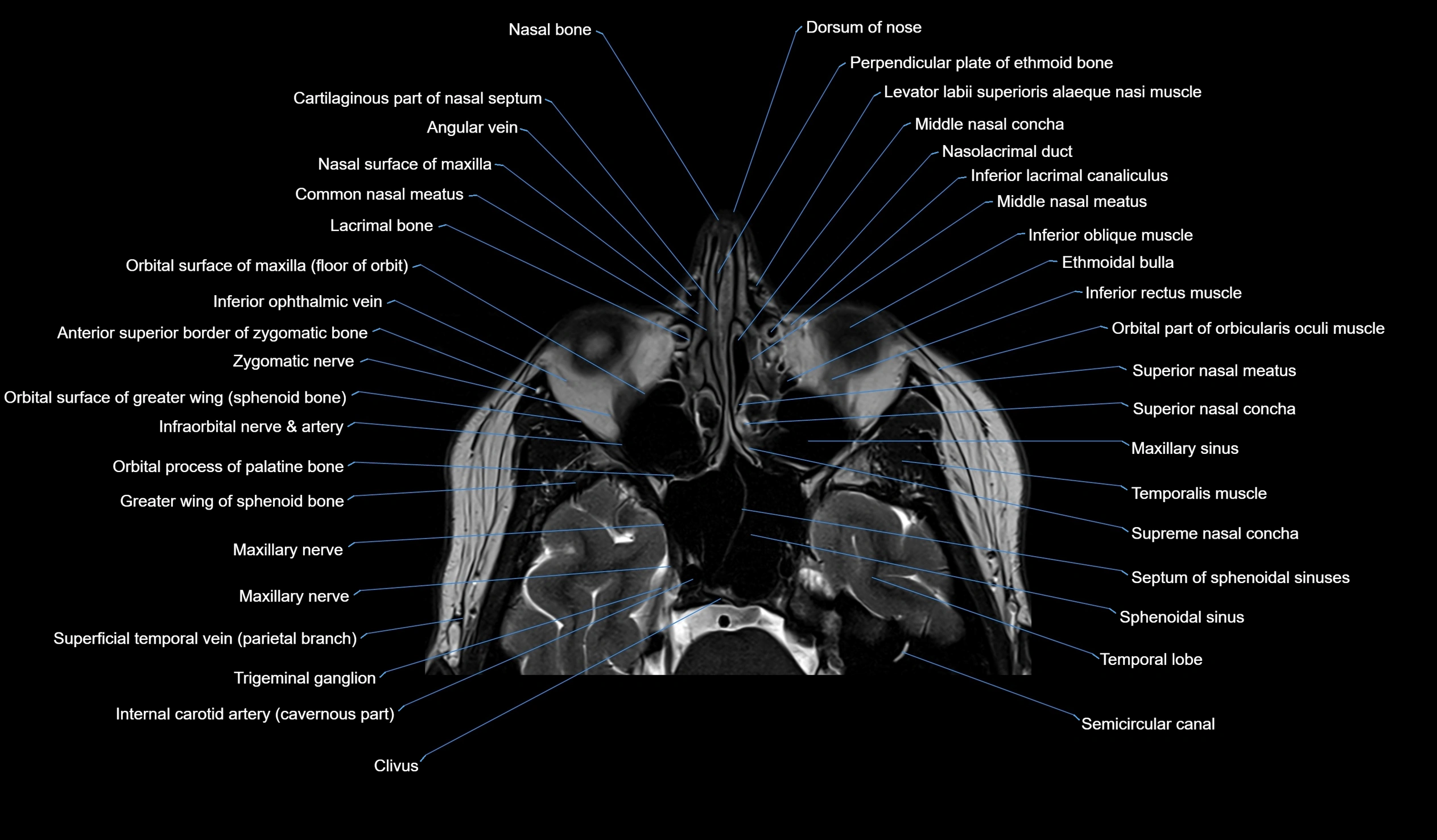 MRI face & paranasal sinuses(PNS) labelled  axial  cross sectional anatomy 3T radiology  image -00017.webp